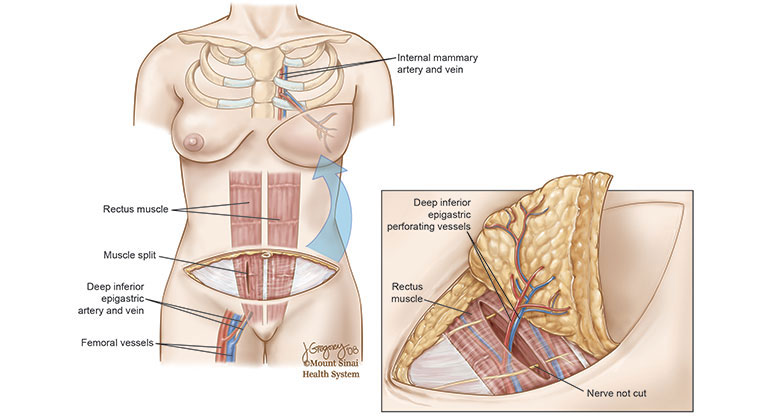 Diagram of Breast Reconstruction