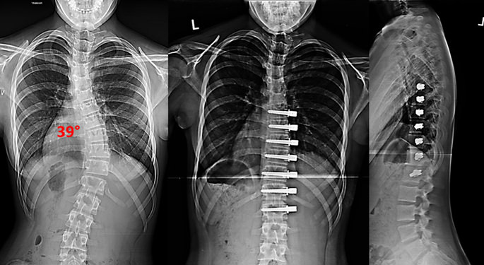 Young Spine Patient, Emiline’s curved spine before and after corrective treatment