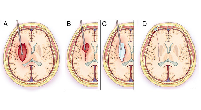drawn images of the surgical stages after stroke
