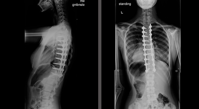 X-ray images of Young Spine Patient, Nina, from side view and back view of straight corrected spine after treatment