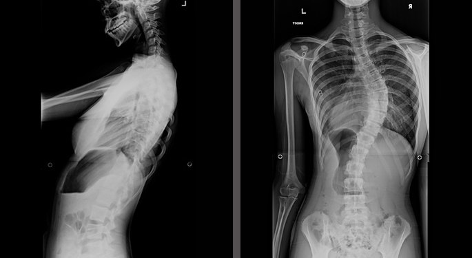 X-ray images of Young Spine Patient, Nina, from side view and back view of spine with curvature before treatment