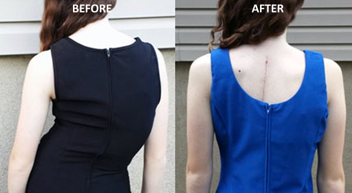 Rear view images of Young Spine Patient, Ruth, before and after corrective surgery
