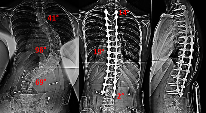 Scoliosis correction