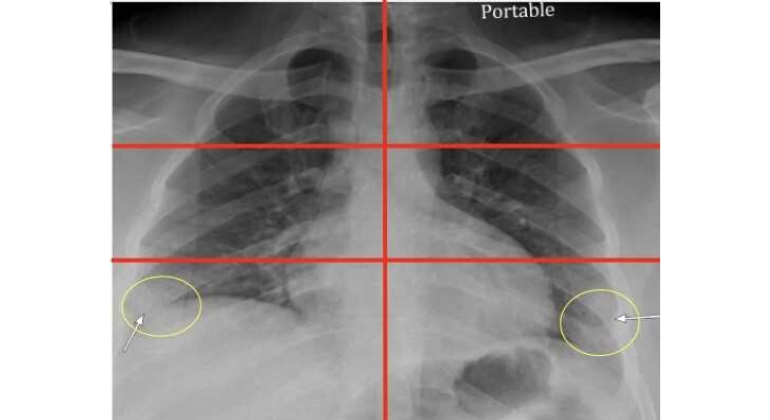 Chest X-ray