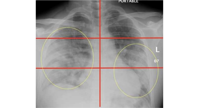 Chest X-Ray