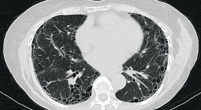 Bronchiectasis & NTM  Mount Sinai - New York