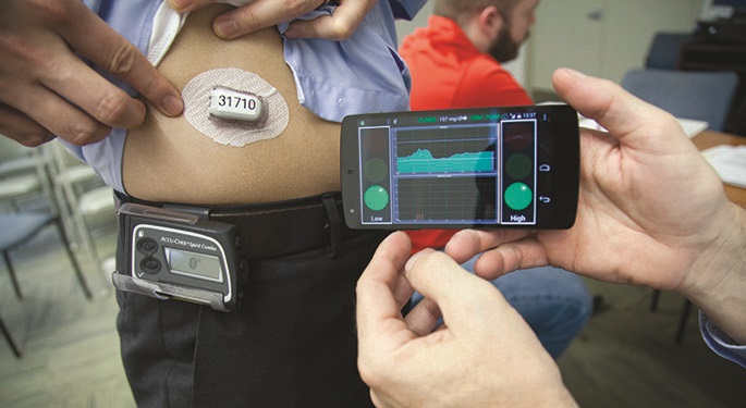 Artificial Pancreas