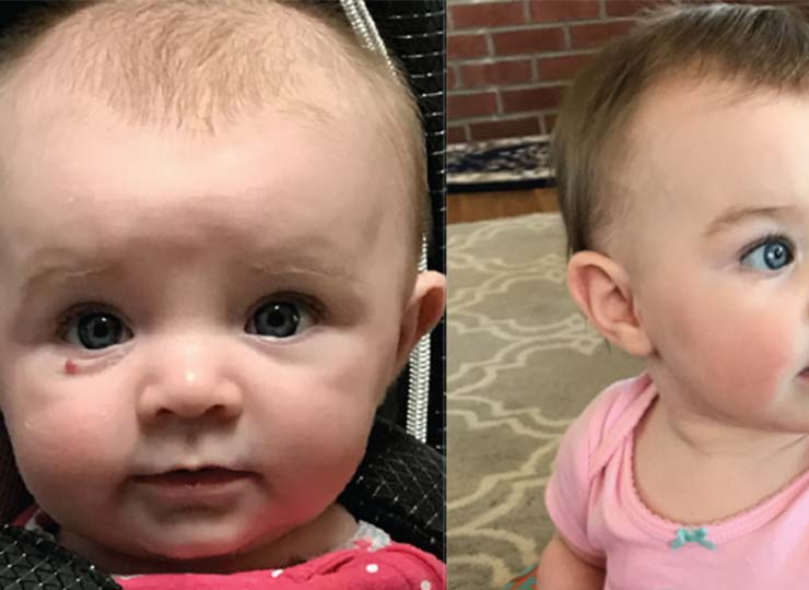 Photo of Before and after picture of baby girl